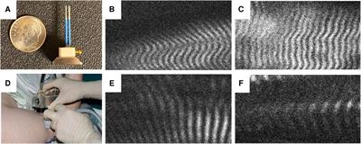 Brachial plexus birth injury and cerebral palsy lead to a common contracture phenotype characterized by reduced functional muscle length and strength
